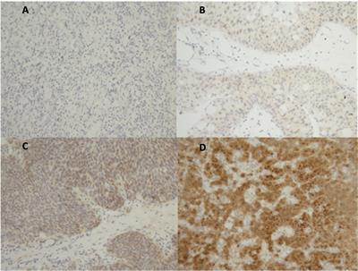 Androgen Receptor Expression Is a Predictor of Poor Outcome in Urothelial Carcinoma
